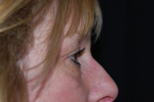 Blepharoplasty Before & After Patient #25068