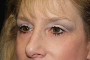 Blepharoplasty Before & After Patient #25068