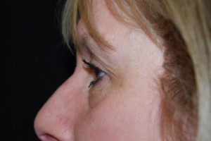 Blepharoplasty Before & After Patient #25068