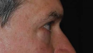 Blepharoplasty Before & After Patient #25069