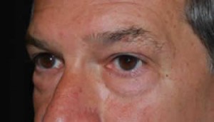 Blepharoplasty Before & After Patient #25069