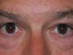 Blepharoplasty Before & After Patient #25069