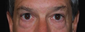 Blepharoplasty Before & After Patient #25069