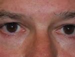 Blepharoplasty Before & After Patient #25069