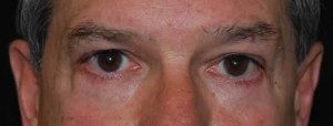 Blepharoplasty Before & After Patient #25069