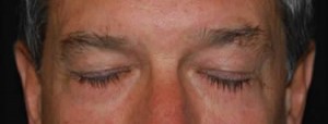 Blepharoplasty Before & After Patient #25069