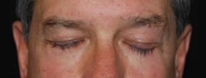 Blepharoplasty Before & After Patient #25069