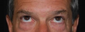 Blepharoplasty Before & After Patient #25069