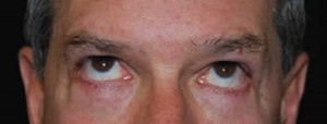 Blepharoplasty Before & After Patient #25069