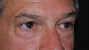 Blepharoplasty Before & After Patient #25069