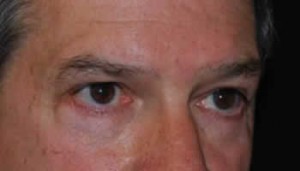 Blepharoplasty Before & After Patient #25069