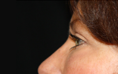 Blepharoplasty Before & After Patient #25092