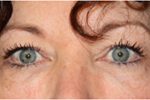 Blepharoplasty Before & After Patient #25092