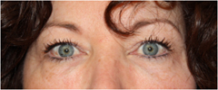 Blepharoplasty Before & After Patient #25092