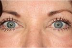 Blepharoplasty Before & After Patient #25092