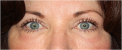 Blepharoplasty Before & After Patient #25092