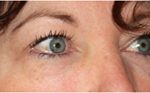 Blepharoplasty Before & After Patient #25092