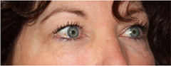 Blepharoplasty Before & After Patient #25092