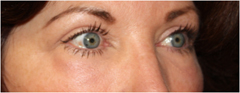 Blepharoplasty Before & After Patient #25092