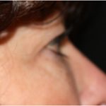 Blepharoplasty Before & After Patient #25092