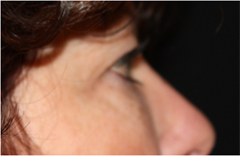 Blepharoplasty Before & After Patient #25092