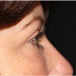 Blepharoplasty Before & After Patient #25092