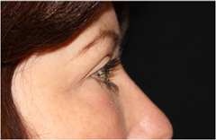 Blepharoplasty Before & After Patient #25092