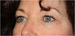 Blepharoplasty Before & After Patient #25092