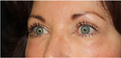 Blepharoplasty Before & After Patient #25092