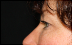 Blepharoplasty Before & After Patient #25092