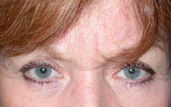 Blepharoplasty Before & After Patient #25093