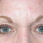 Blepharoplasty Before & After Patient #25093