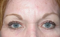 Blepharoplasty Before & After Patient #25093
