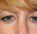 Blepharoplasty Before & After Patient #24942