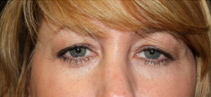 Blepharoplasty Before & After Patient #24942