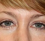 Blepharoplasty Before & After Patient #24942