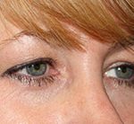 Blepharoplasty Before & After Patient #24942