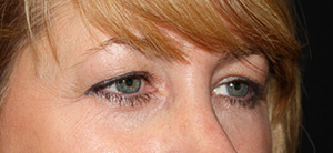 Blepharoplasty Before & After Patient #24942