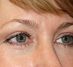 Blepharoplasty Before & After Patient #24942