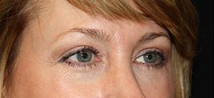 Blepharoplasty Before & After Patient #24942