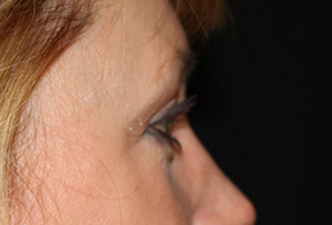 Blepharoplasty Before & After Patient #24942