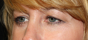 Blepharoplasty Before & After Patient #24942