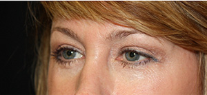 Blepharoplasty Before & After Patient #24942