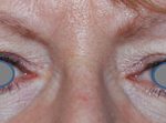 Blepharoplasty Before & After Patient #25106