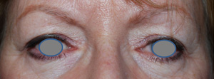 Blepharoplasty Before & After Patient #25106