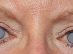 Blepharoplasty Before & After Patient #25106