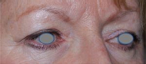 Blepharoplasty Before & After Patient #25106