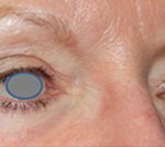 Blepharoplasty Before & After Patient #25106