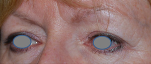 Blepharoplasty Before & After Patient #25106