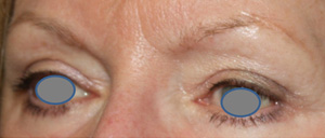 Blepharoplasty Before & After Patient #25106